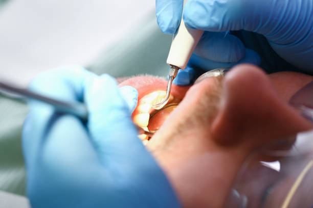 Best Chipped Tooth Repair Near Me  in Aviston, IL